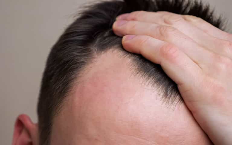Follically challenged, rejoice – scientists have discovered a potential cure for baldness Follically challenged, rejoice – scientists have discovered a potential cure for baldness