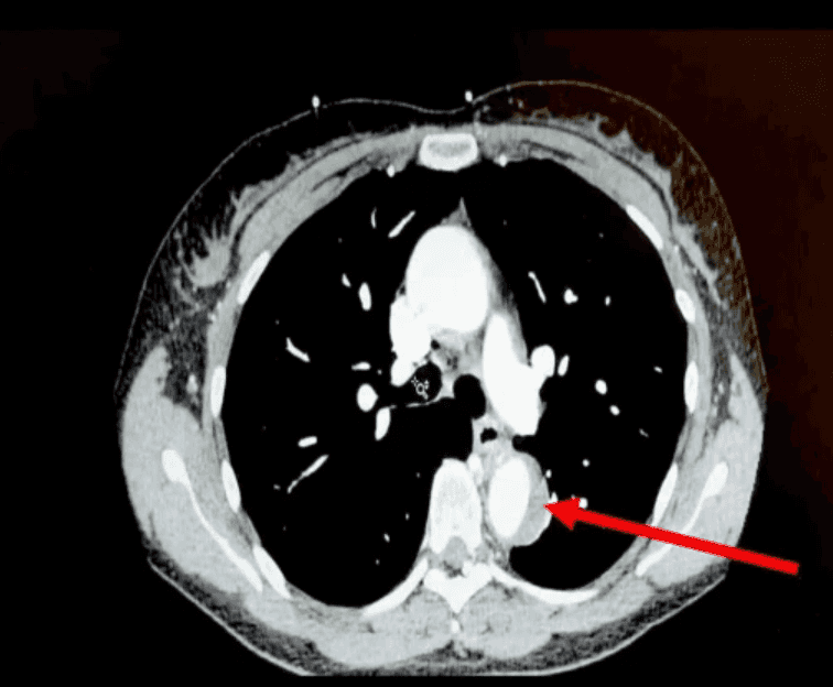 Woman almost died during sex when orgasm popped aorta Woman almost died during sex when orgasm popped aorta