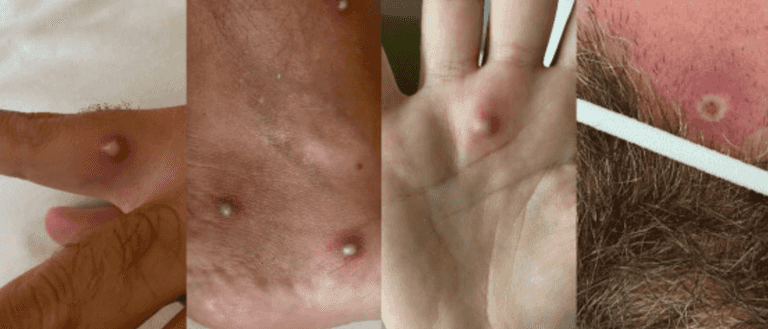 Man tests positive for monkeypox, HIV and Covid all at once Man tests positive for monkeypox, HIV and Covid all at once