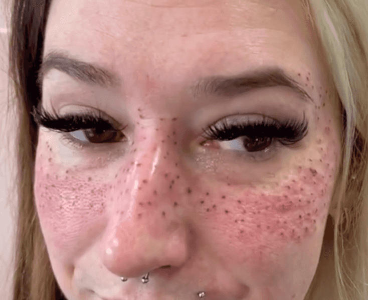 Tattoo artist shows of freckle inkings she did for happy customer who travelled 900 miles for appointment Tattoo artist shows of freckle inkings she did for happy customer who travelled 900 miles for appointment