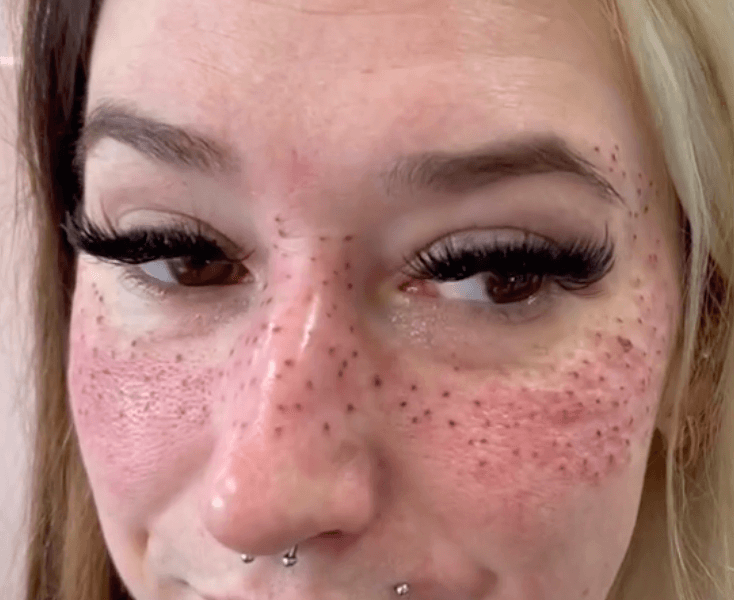 Tattoo artist shows of freckle inkings she did for happy customer who travelled 900 miles for appointment Tattoo artist shows of freckle inkings she did for happy customer who travelled 900 miles for appointment