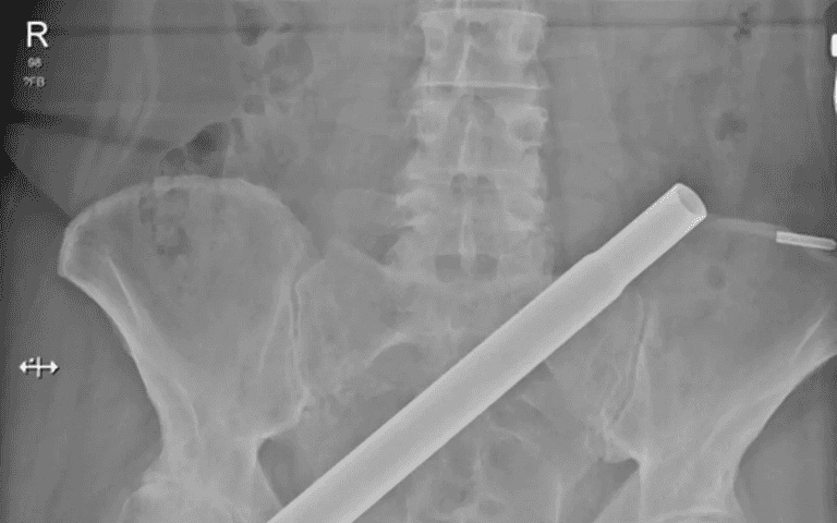 Terrifying CT scan shows how woman was impaled by Christmas tree Terrifying CT scan shows how woman was impaled by Christmas tree