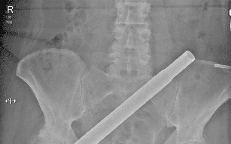 Terrifying CT scan shows how woman was impaled by Christmas tree Terrifying CT scan shows how woman was impaled by Christmas tree
