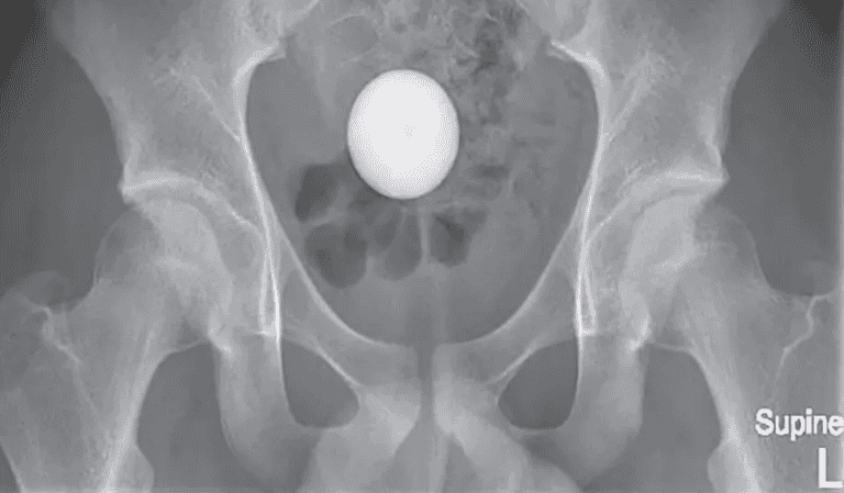 Boy, 14, has golf ball removed from his butt Boy, 14, has golf ball removed from his butt