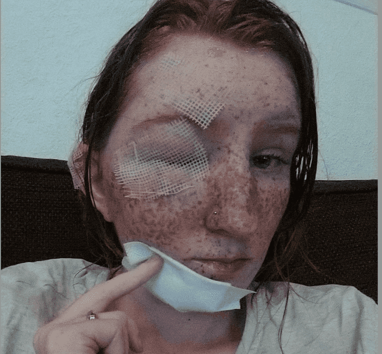 Woman’s freckles melted off after brother-in-law attacked her with boiling water during row over pet rat Woman’s freckles melted off after brother-in-law attacked her with boiling water during row over pet rat
