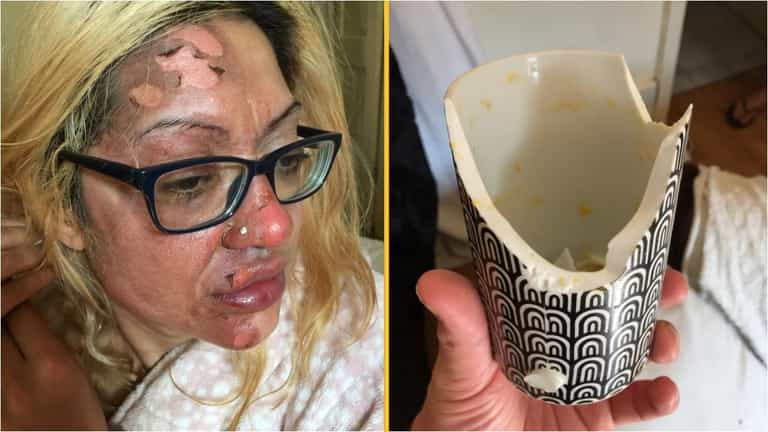Mum left in ‘agony’ after following viral TikTok poached egg ‘hack’ Mum left in ‘agony’ after following viral TikTok poached egg ‘hack’