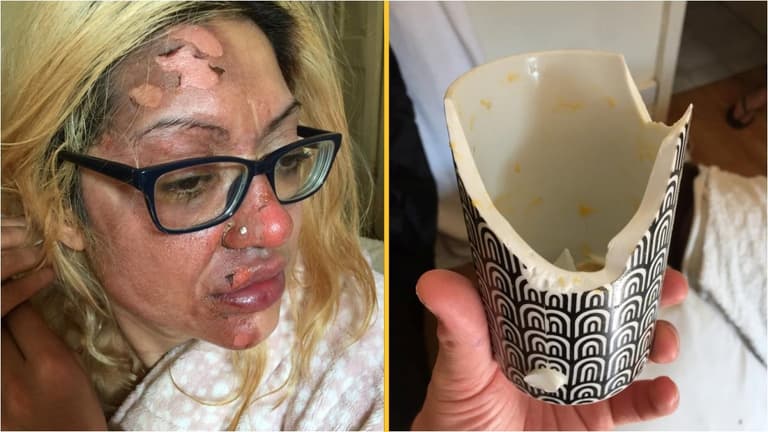 Mum left in ‘agony’ after following viral TikTok poached egg ‘hack’ Mum left in ‘agony’ after following viral TikTok poached egg ‘hack’