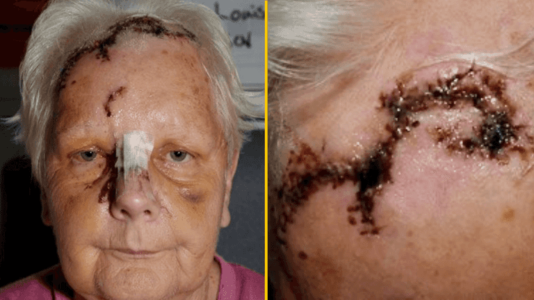 Pensioner given just £500 compensation after neighbour’s dog ripped her scalp down to the skull Pensioner given just £500 compensation after neighbour’s dog ripped her scalp down to the skull