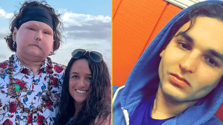 Man, 24, who underwent world’s first face and double hand transplant finds love Man, 24, who underwent world’s first face and double hand transplant finds love