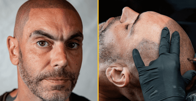 Bald man spends thousands to have hair tattooed on his head Bald man spends thousands to have hair tattooed on his head