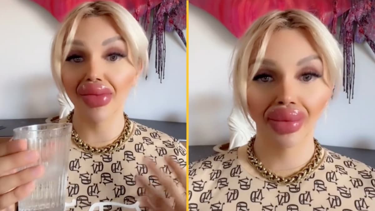 Woman who’s undergone huge lip injections says it’s difficult to eat and drink