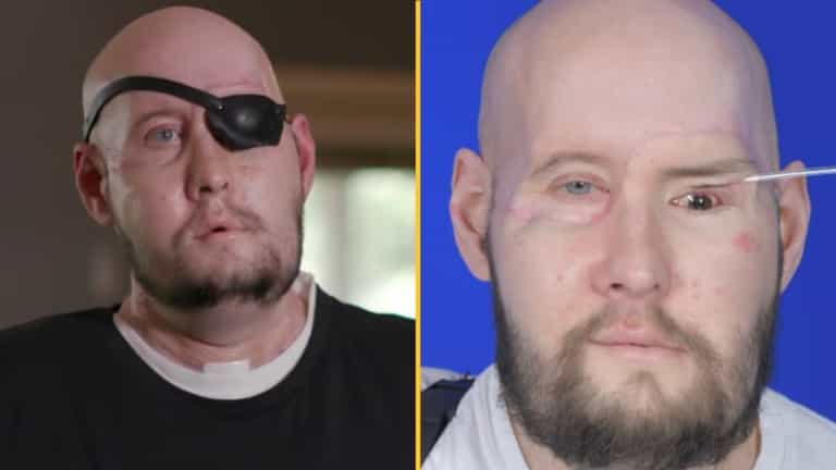 Man receives first-ever eye transplant after losing half his face in electrocution Man receives first-ever eye transplant after losing half his face in electrocution