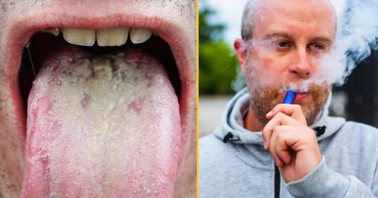 Dentist issues warning over ‘Vaper’s Tongue’ this Christmas Dentist issues warning over ‘Vaper’s Tongue’ this Christmas