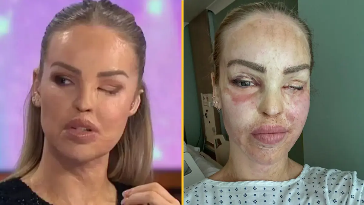 Katie Piper gives update after her eye is sewn shut for a year