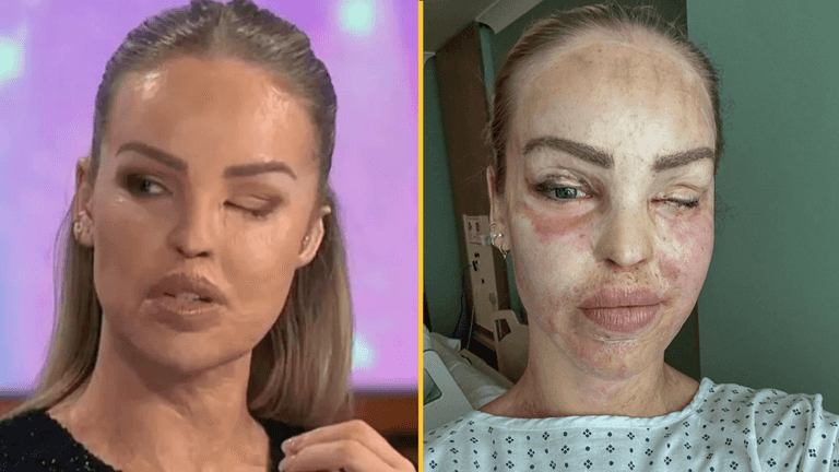 Katie Piper gives update after her eye is sewn shut for a year Katie Piper gives update after her eye is sewn shut for a year