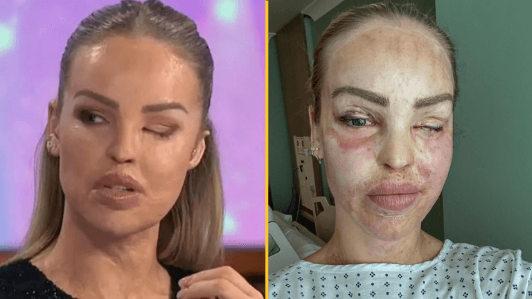Katie Piper gives update after her eye is sewn shut for a year Katie Piper gives update after her eye is sewn shut for a year