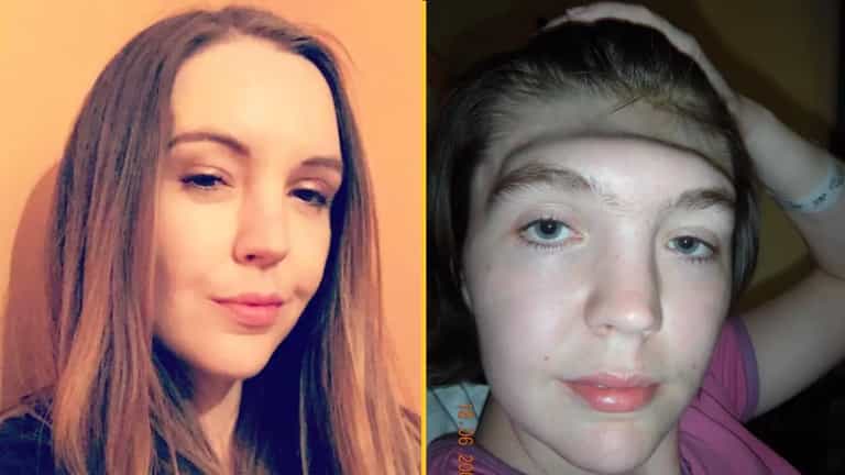 Woman warns against putting feet on dashboard after she lost entire forehead Woman warns against putting feet on dashboard after she lost entire forehead
