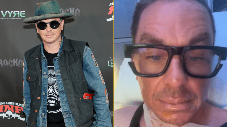 Slipknot star in hospital with ‘serious burns’ after ‘setting himself on fire’ Slipknot star in hospital with ‘serious burns’ after ‘setting himself on fire’