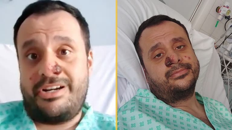 Mpox patient describes ‘horrendous symptoms’ after contracting the virus Mpox patient describes ‘horrendous symptoms’ after contracting the virus