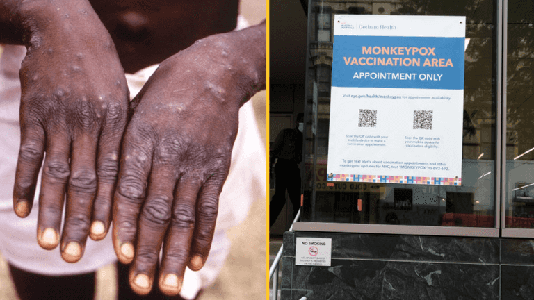 Mpox symptoms to be aware of as WHO declares ‘global emergency’ Mpox symptoms to be aware of as WHO declares ‘global emergency’