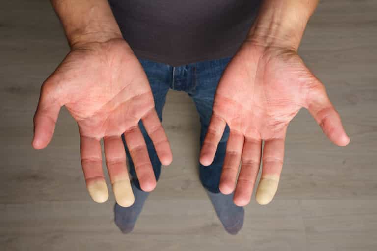 Millions of Brits suffer common disease where fingers turn white during winter months Millions of Brits suffer common disease where fingers turn white during winter months