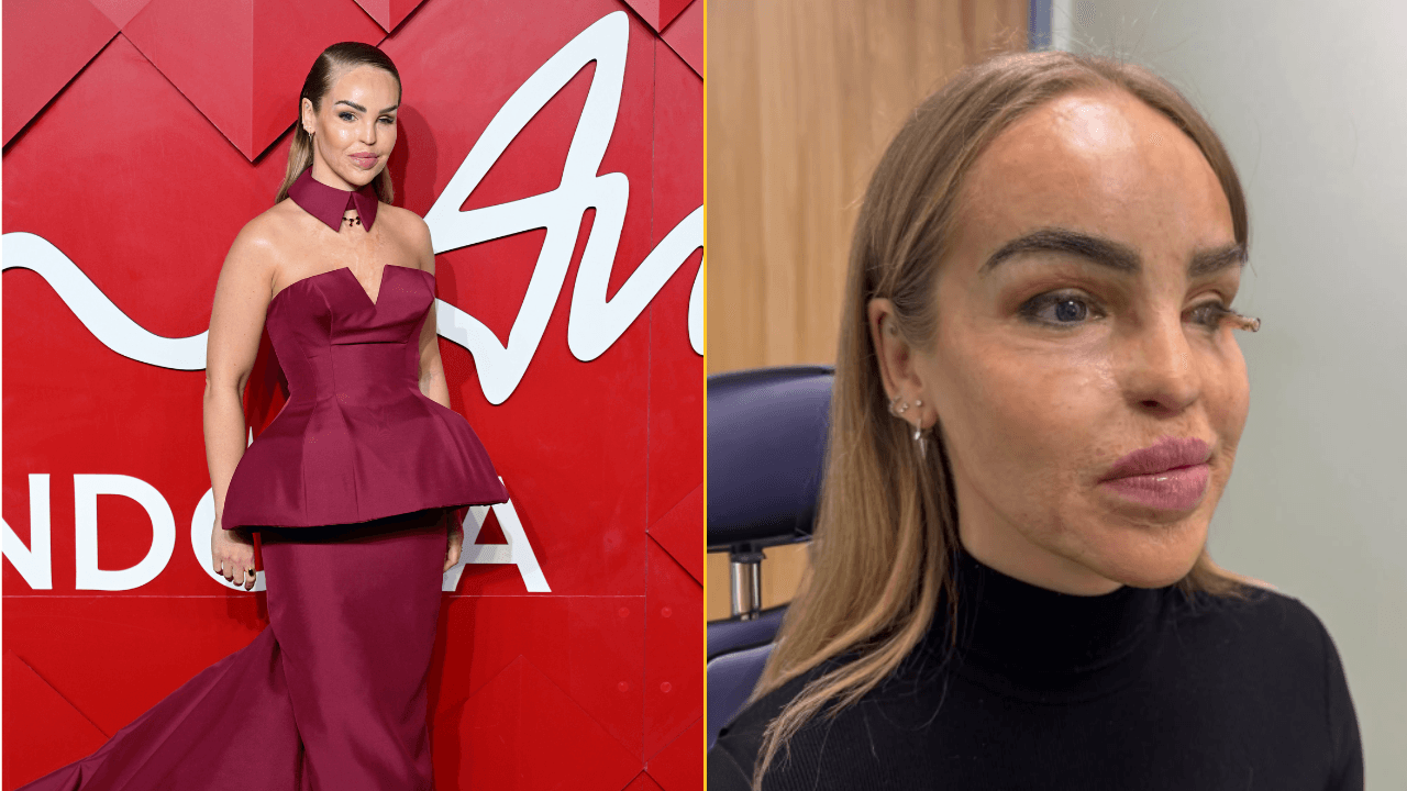 Katie Piper issues update on eye health after having it sewn shut for a year