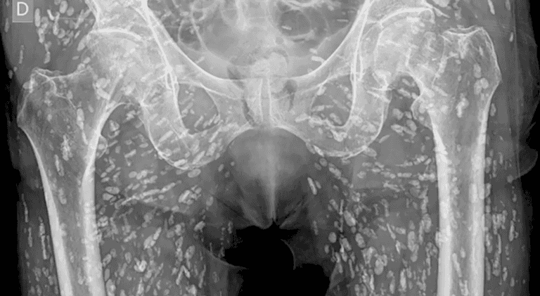 Horrifying X-ray shows tapeworms breeding inside man’s body after he made vital kitchen error Horrifying X-ray shows tapeworms breeding inside man’s body after he made vital kitchen error