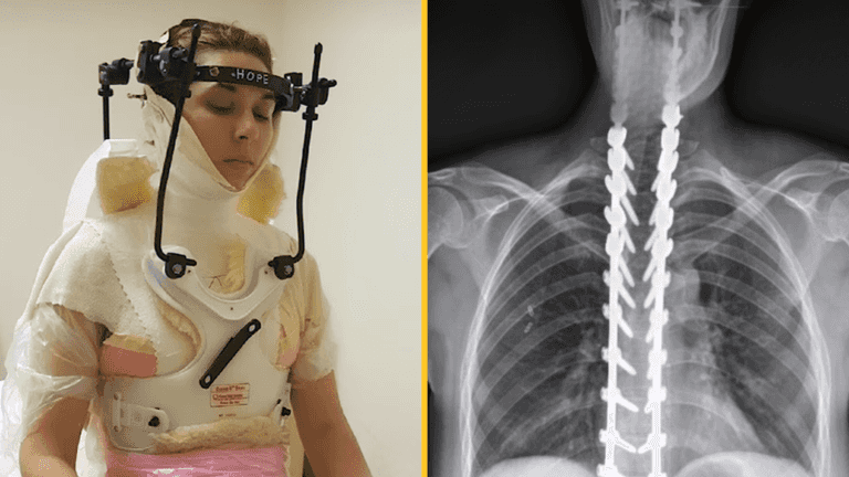 Woman has skull reattached after being ‘decapitated’ in freak football injury Woman has skull reattached after being ‘decapitated’ in freak football injury