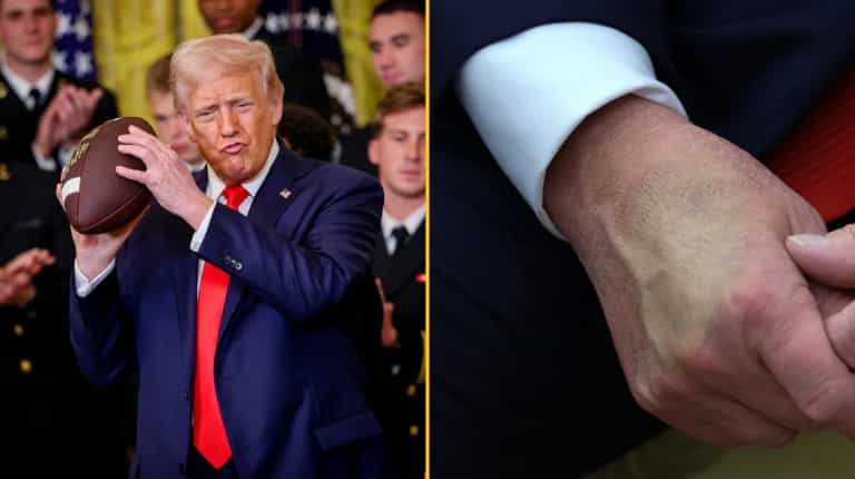 People worried for Donald Trump’s health after spotting mysterious bruises in new photo People worried for Donald Trump’s health after spotting mysterious bruises in new photo