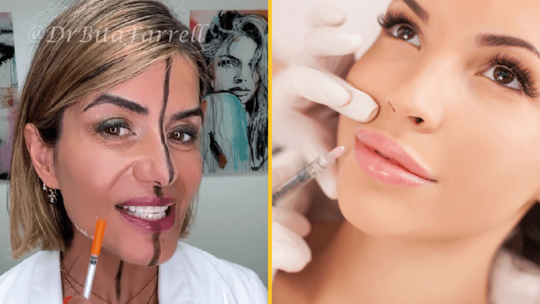 Doctor shares side effects of Botox after injecting only one side of her face Doctor shares side effects of Botox after injecting only one side of her face