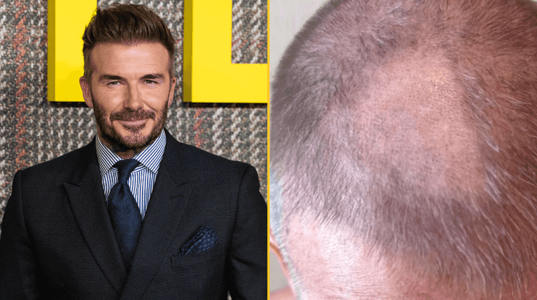 David Beckham left with ‘terrible’ bald patch after trying to cut his own hair David Beckham left with ‘terrible’ bald patch after trying to cut his own hair