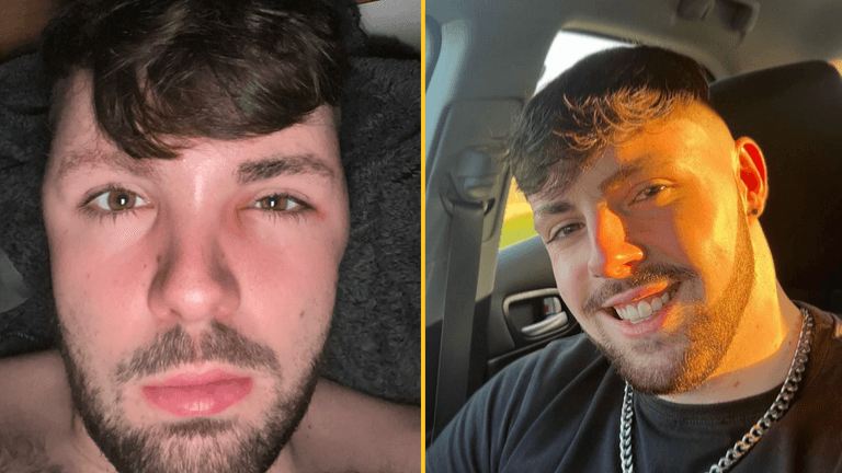 Man who ignored ‘no sex’ advice after hair transplant instantly regrets it Man who ignored ‘no sex’ advice after hair transplant instantly regrets it