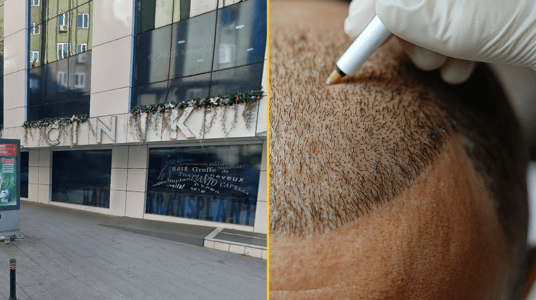 Brit tourist dies in Turkey after hair transplant goes wrong Brit tourist dies in Turkey after hair transplant goes wrong