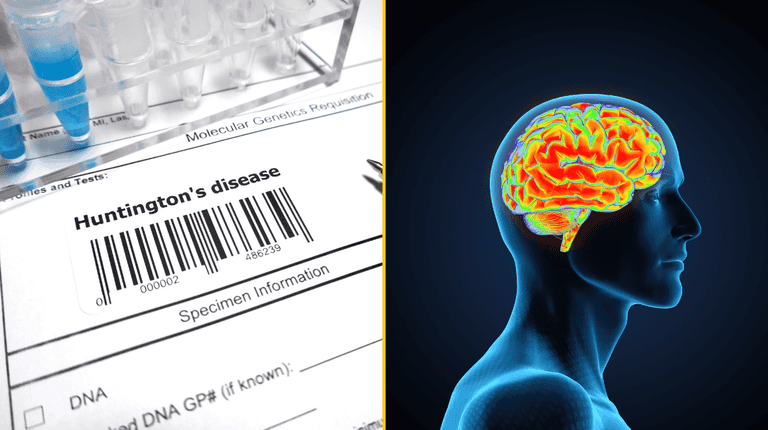 Huntington’s disease successfully treated for first time Huntington’s disease successfully treated for first time