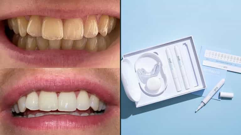 Shoppers praise teeth whitening kit that ‘shows results within days’ – and it’s 50% off Shoppers praise teeth whitening kit that ‘shows results within days’ – and it’s 50% off
