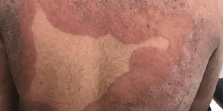 Drug-resistant fungus that attacks bum and groin is spreading rapidly across UK Drug-resistant fungus that attacks bum and groin is spreading rapidly across UK