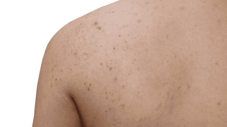 This is the perfect product to use if you suffer from stubborn body acne This is the perfect product to use if you suffer from stubborn body acne