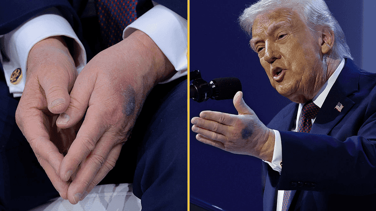 Reason for the bruises on Donald Trump’s hands revealed Reason for the bruises on Donald Trump’s hands revealed
