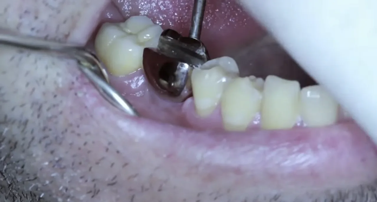 Video Rugby players receive tooth implant that doubles as a bottle