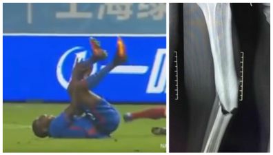 Demba Ba’s X-Ray released after horrific leg break