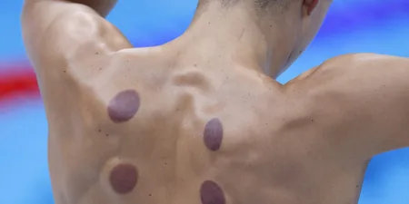 What are the dark circles on swimmers’ backs at Paris Olympics