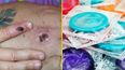 Doctors concerned about impact of Monkeypox on sexual health