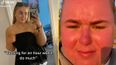 Woman’s face ‘doubles in size’ after spending just an hour in the sun