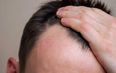 Follically challenged, rejoice – scientists have discovered a potential cure for baldness