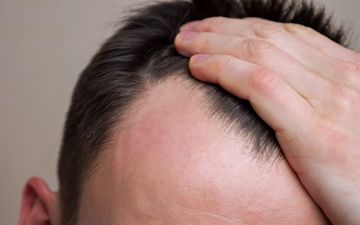 Follically challenged, rejoice – scientists have discovered a potential cure for baldness