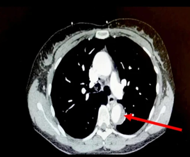 Woman almost died during sex when orgasm popped aorta