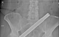 Terrifying CT scan shows how woman was impaled by Christmas tree