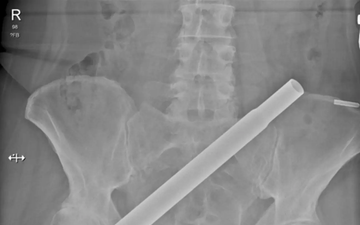 Terrifying CT scan shows how woman was impaled by Christmas tree