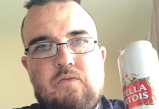 Man gets full sized Stella tattoo on his head because he loves the drink that much