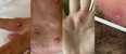 Man tests positive for monkeypox, HIV and Covid all at once